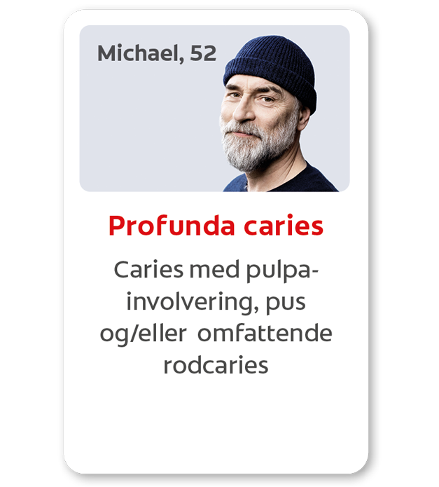 Caries med pulpa-involvering, pus og/eller omfattende rodcaries 