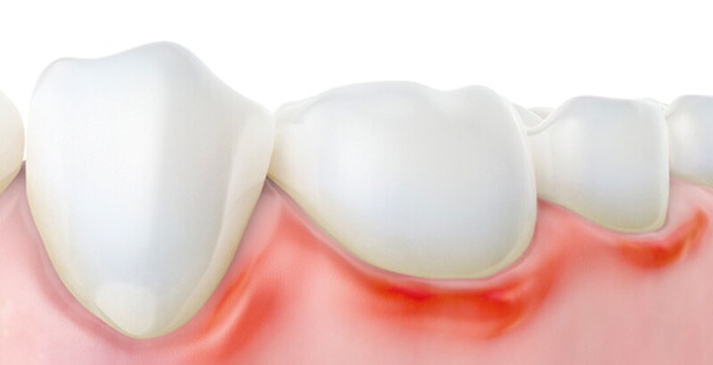 Parodontale sygdomme